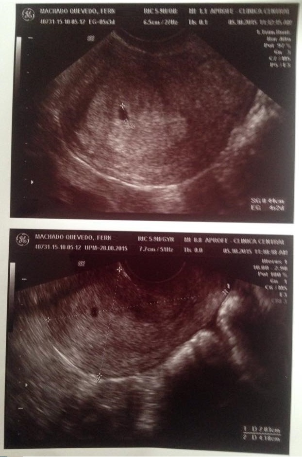 Eco de ambarazo positivo de Fernando Machado y Diane Rodríguez - 2015